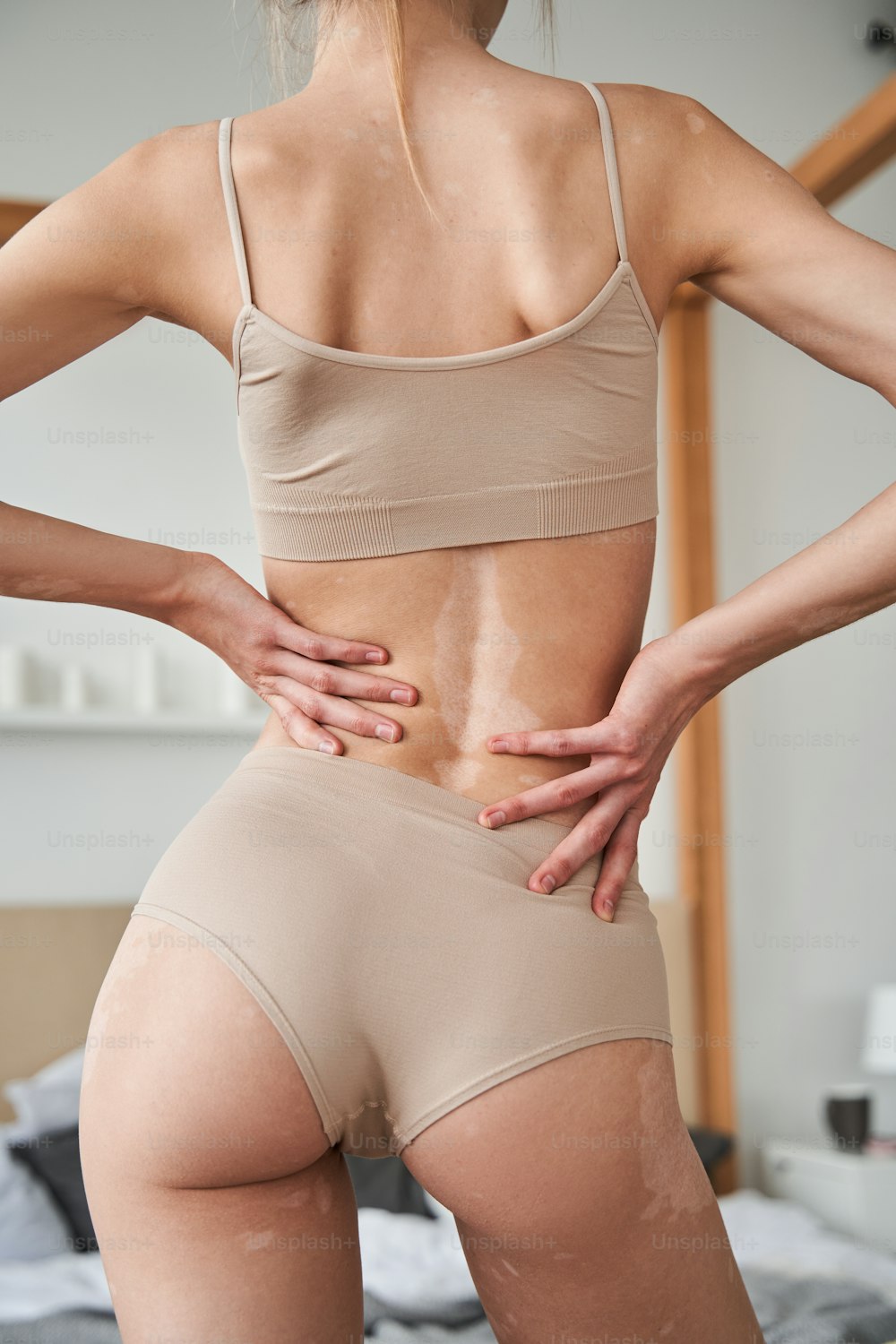 People, dermatology, cosmetology and skin condition concept. Back view of attractive young caucasian female wearing beige bra showing white vitiligo spots while posing at her flat