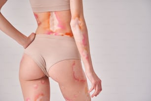 Perfect body. Cropped view of the caucasian girl wearing beige underwear showing her vitiligo skin to the camera while posing at the white background. Her moles highlighted with bright paint