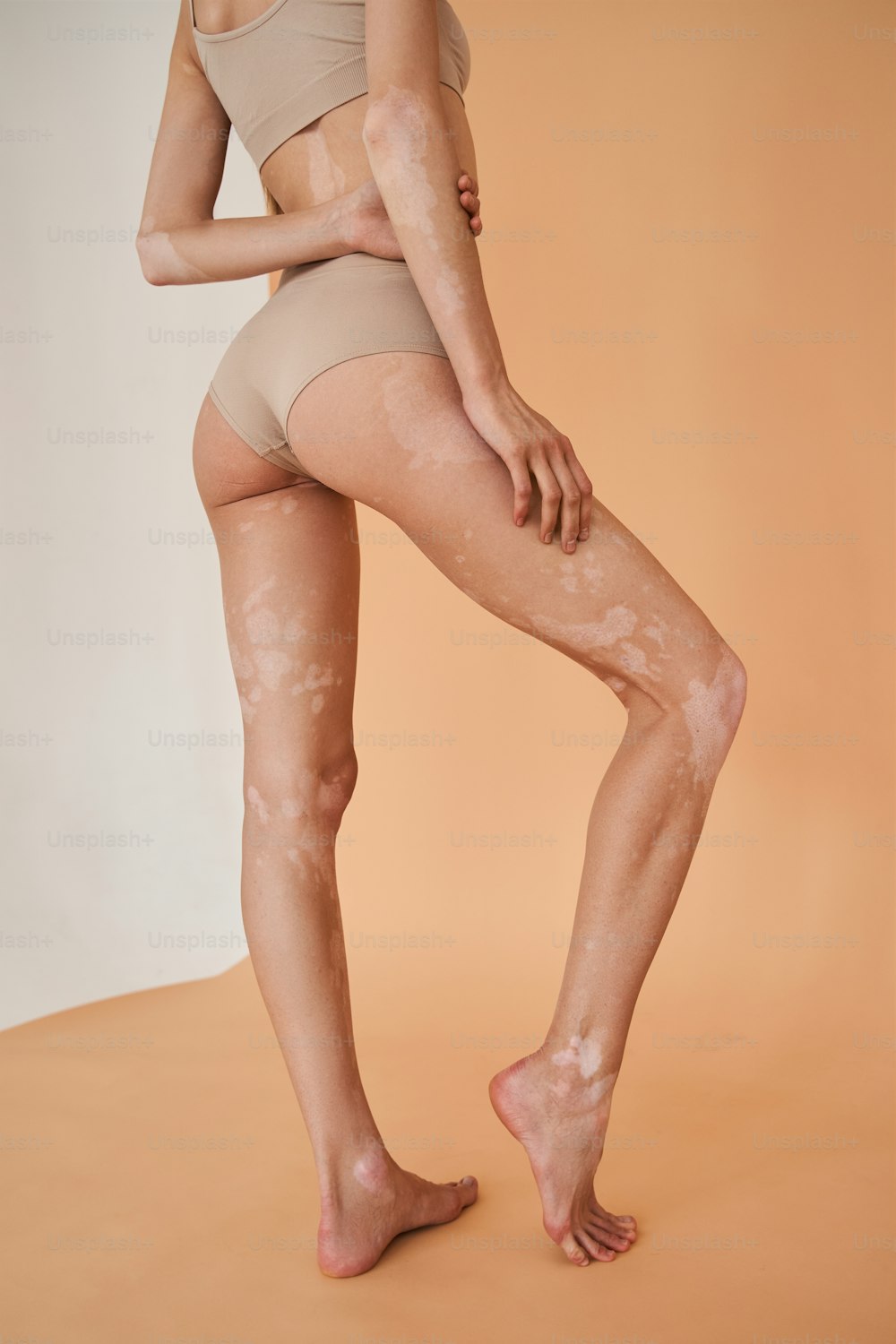 Cropped view of the young vitiligo skin woman is boasting of her figure while posing at the studio with beige background. Skin disorders and woman appearance concept