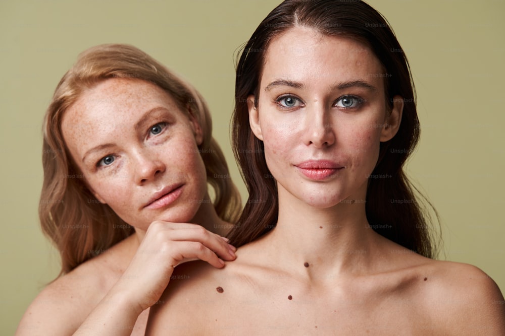 Cute blonde freckled woman standing behind the brunette girl with acne face and posing together at the professional photo session