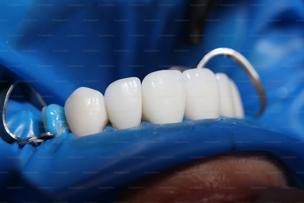 Instalación de carillas e implantes dentales en clínica closeup. Concepto de prótesis dental