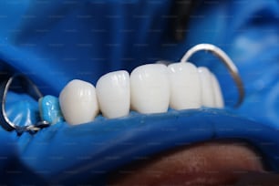 Einsetzen von Veneers und Zahnimplantaten in Nahaufnahme der Klinik. Konzept der Zahnprothetik