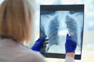 Doctor holds x-ray in hospital. Diagnosis concept of pneumonia covid-19 and bronchitis