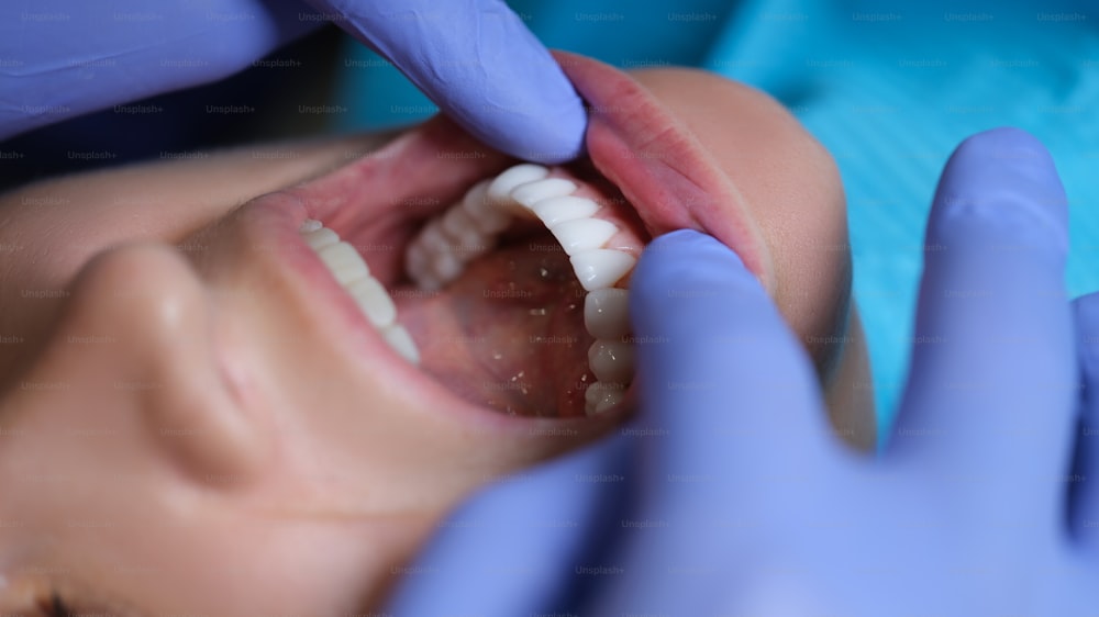 Médico dentista examinando la cavidad oral del paciente con carillas de cerca. Instalación del concepto de carillas de composite y zirconio