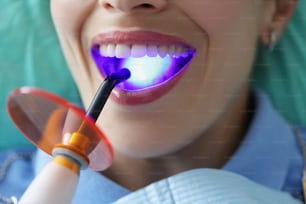 Dentista médico preenche os dentes do paciente com luz de cura. Conceito de instalação de tratamento e enchimento de cárie