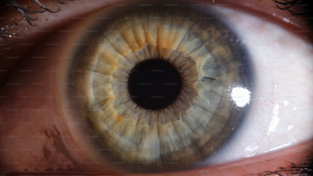 Primo piano dell'occhio rosso danneggiato o irritato. Cornea dell'occhio con il concetto di vasi rossi