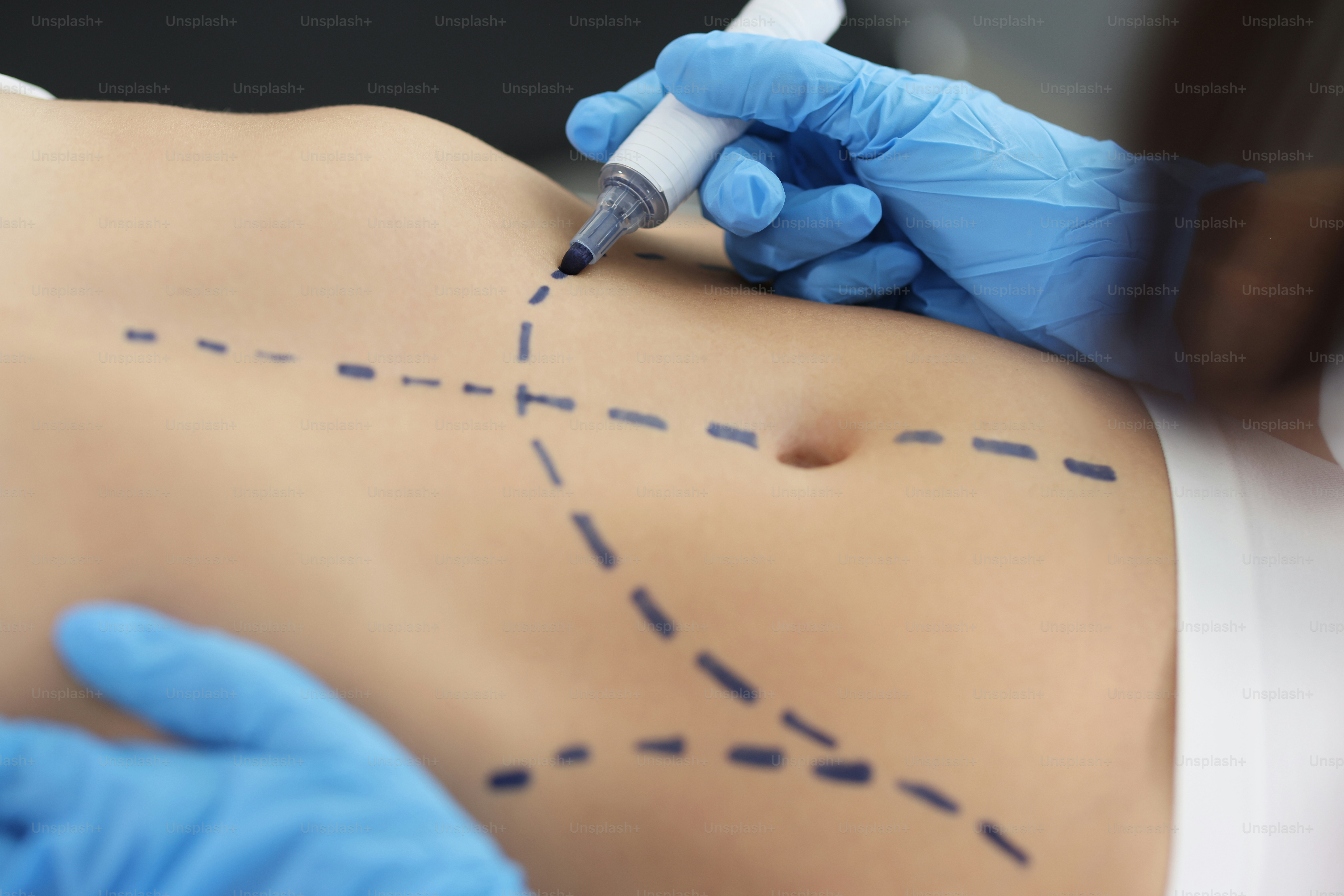 Close-up of plastic surgeon using marker pen while marking belly part of womans body. Procedure before plastic surgery. Cosmetic surgery, beauty concept