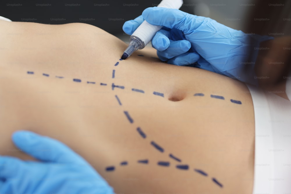 Close-up of plastic surgeon using marker pen while marking belly part of womans body. Procedure before plastic surgery. Cosmetic surgery, beauty concept