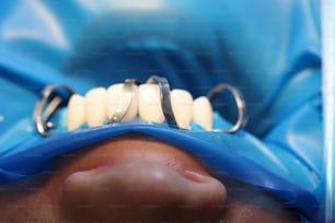 Dentista dental. Concepto de odontología del cuidado dental sobre fondo azul.