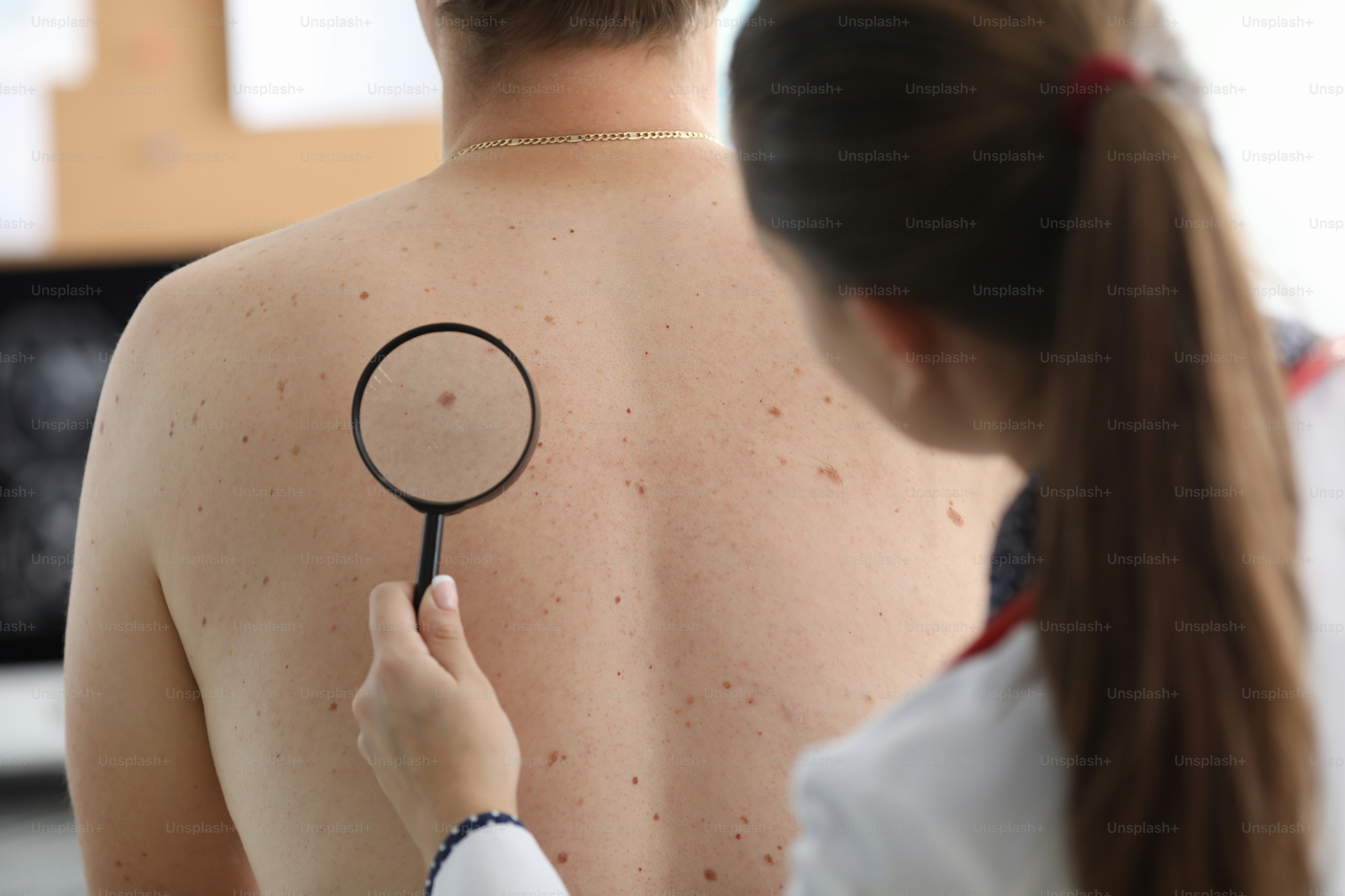 Vista de cerca de un joven dermatólogo examinando el melanoma en el cuerpo de los pacientes. Doctora revisando lunar marrón en la espalda. Concepto de tratamiento clínico y asistencia sanitaria