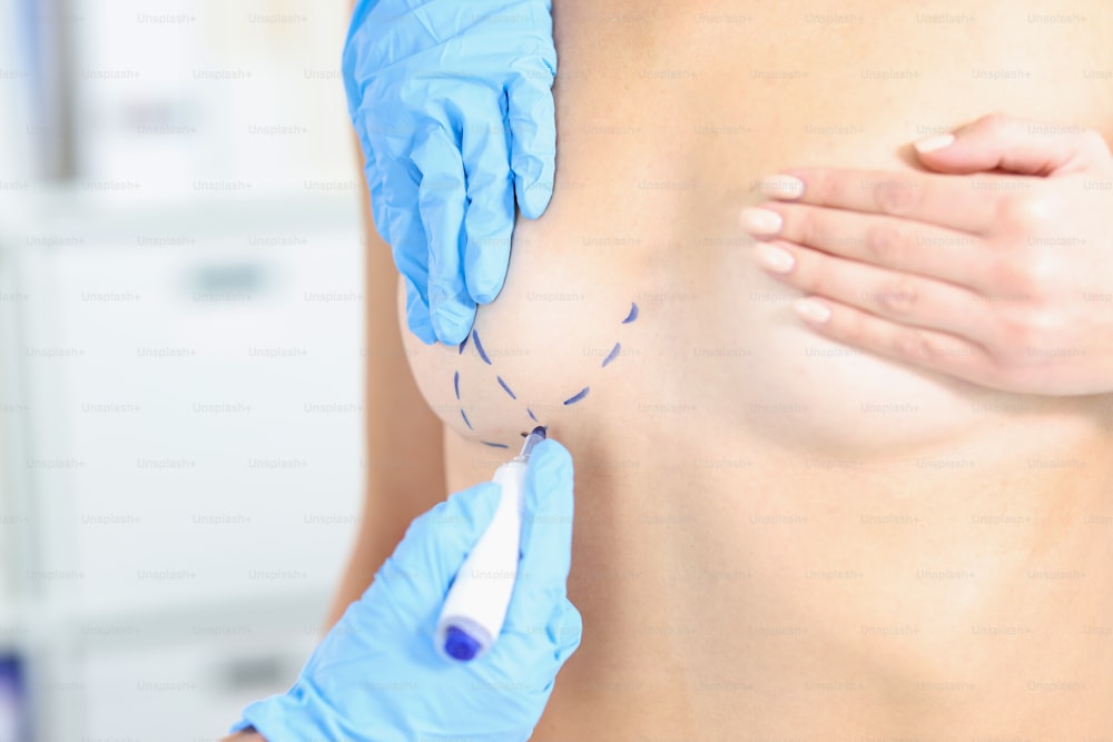 미래의 성형 수술 수술을 위해 가슴에 마킹을 하는 의사의 클로즈업. 수술 준비. 성형 외과, 의학 개념