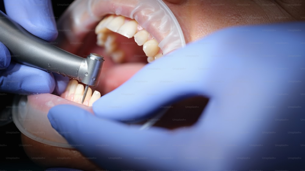 Der Zahnarzt bereitet die Zähne der Frau auf die Installation von Keramikveneers und Kronen mit einem Bohrer vor. Prothetische Zahnheilkunde und kieferorthopädische Behandlung