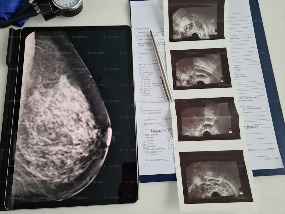 Röntgenuntersuchung der Brustdrüsen und Krankenakte des Patienten. Mammographie- und Brustkrebskonzept
