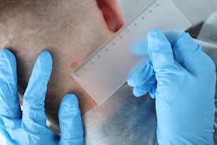 Close-up of medical worker measure with ruler mole on patient neck, man checkup birthmark in hospital. Doctor examine red blemish. Diagnostic, cure concept