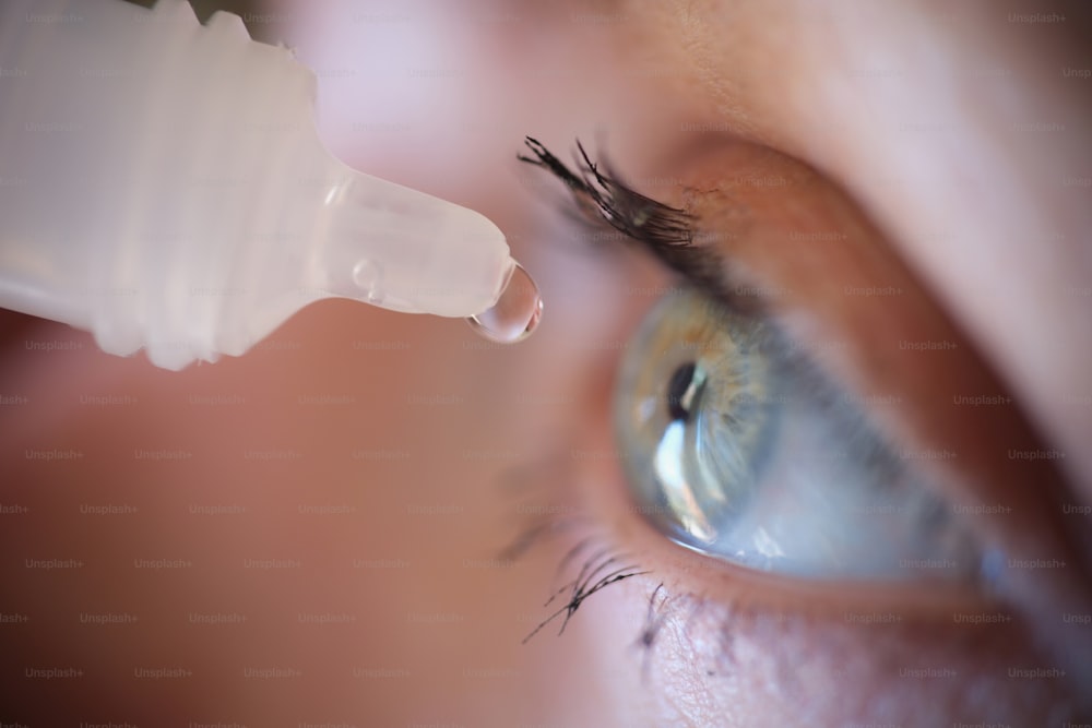 Femme dégoulinant de gouttes d’une bouteille en plastique dans ses yeux en gros plan. Concept de traitement de la conjonctivite allergique