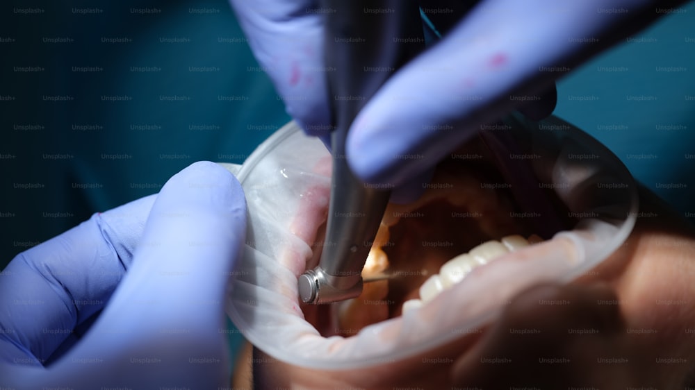 歯科医は歯科用椅子で患者に歯をドリルします。虫歯治療のコンセプト