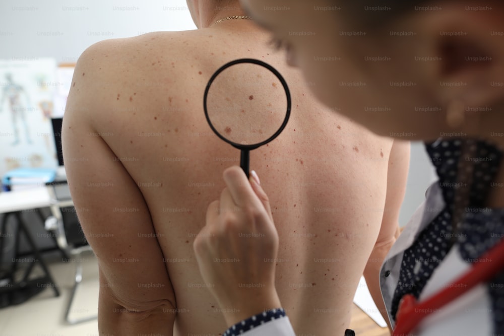 虫眼鏡を手にした腫瘍医が、クリニックで患者の背中の色素性母斑を検査します。悪性皮膚腫瘍の診断と治療の概念。