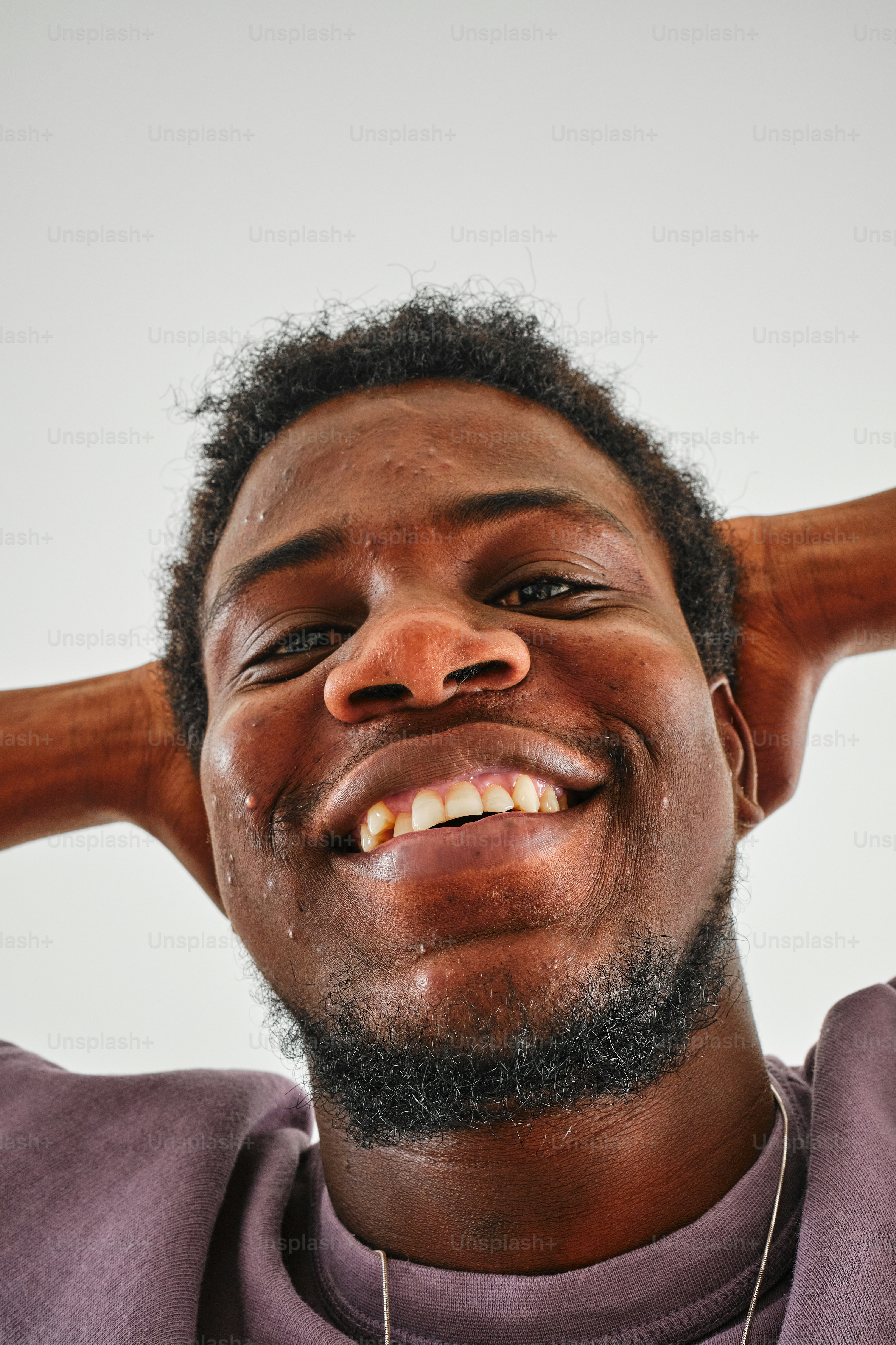 Portrait of positive African man with acne skin