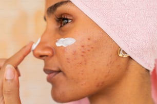 una donna con l'acne sul viso e un asciugamano in testa