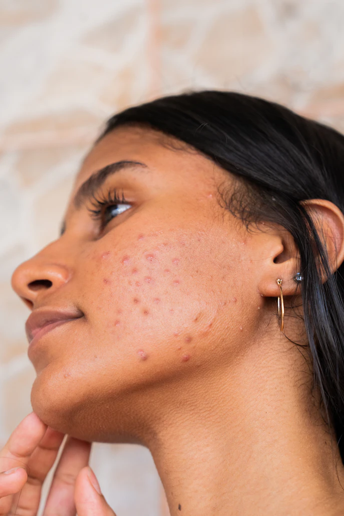 Struggling With Acne? Here's How to Clear Your Skin Naturally