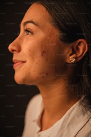 a woman with acne on her face