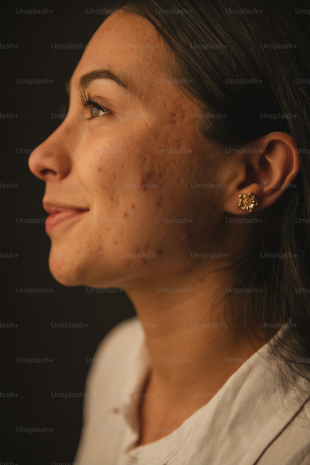 una mujer con acné en la cara
