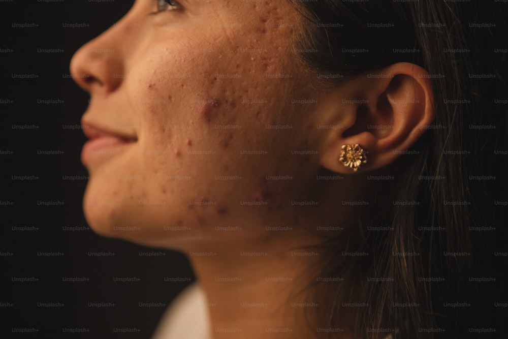 a woman with acne on her face