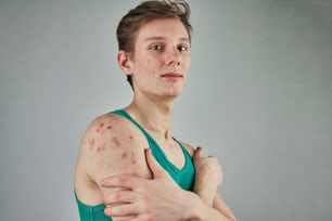 a woman holding her arm with a lot of freckles on it