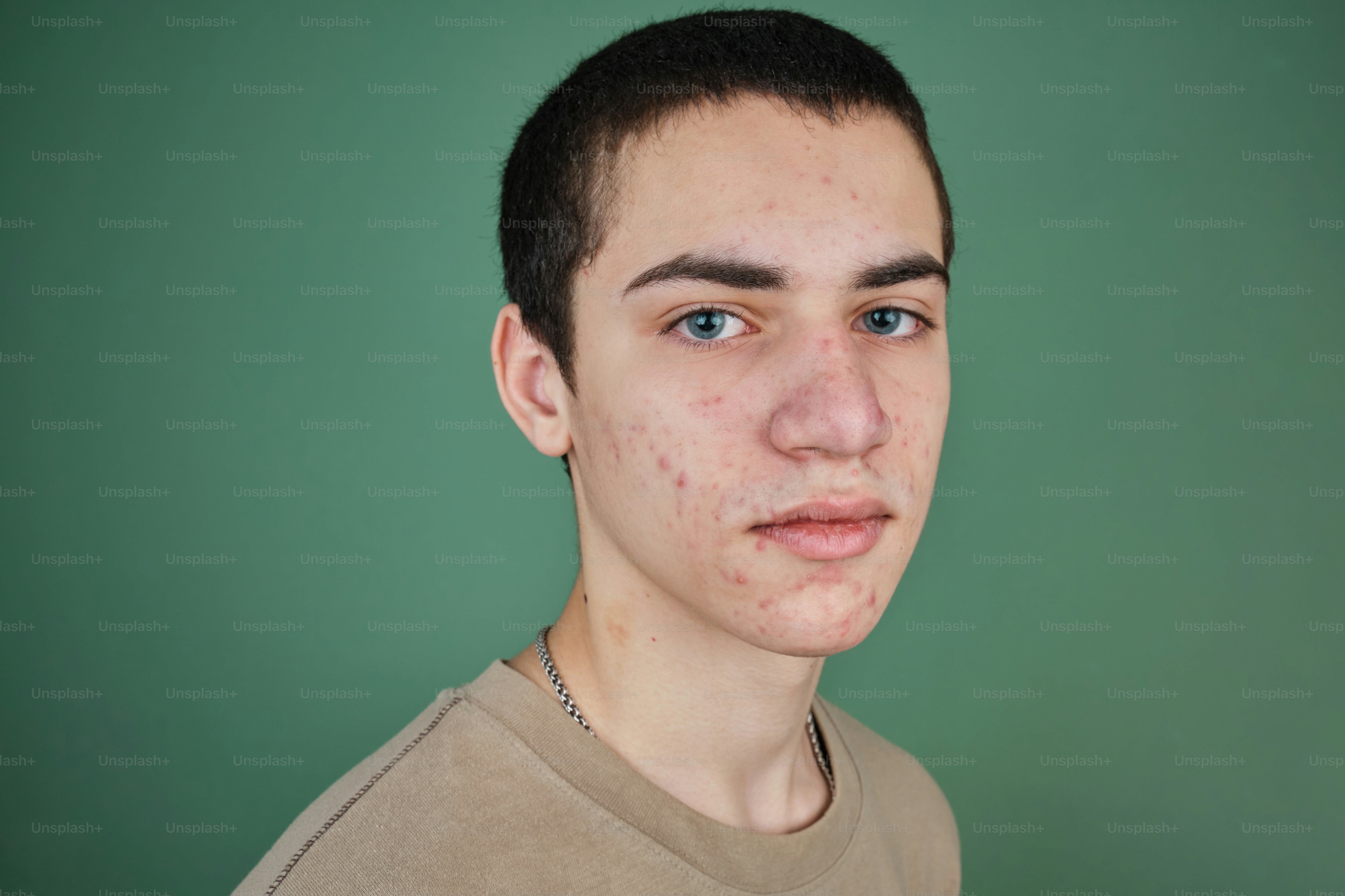 Studio portrait of guy with acne