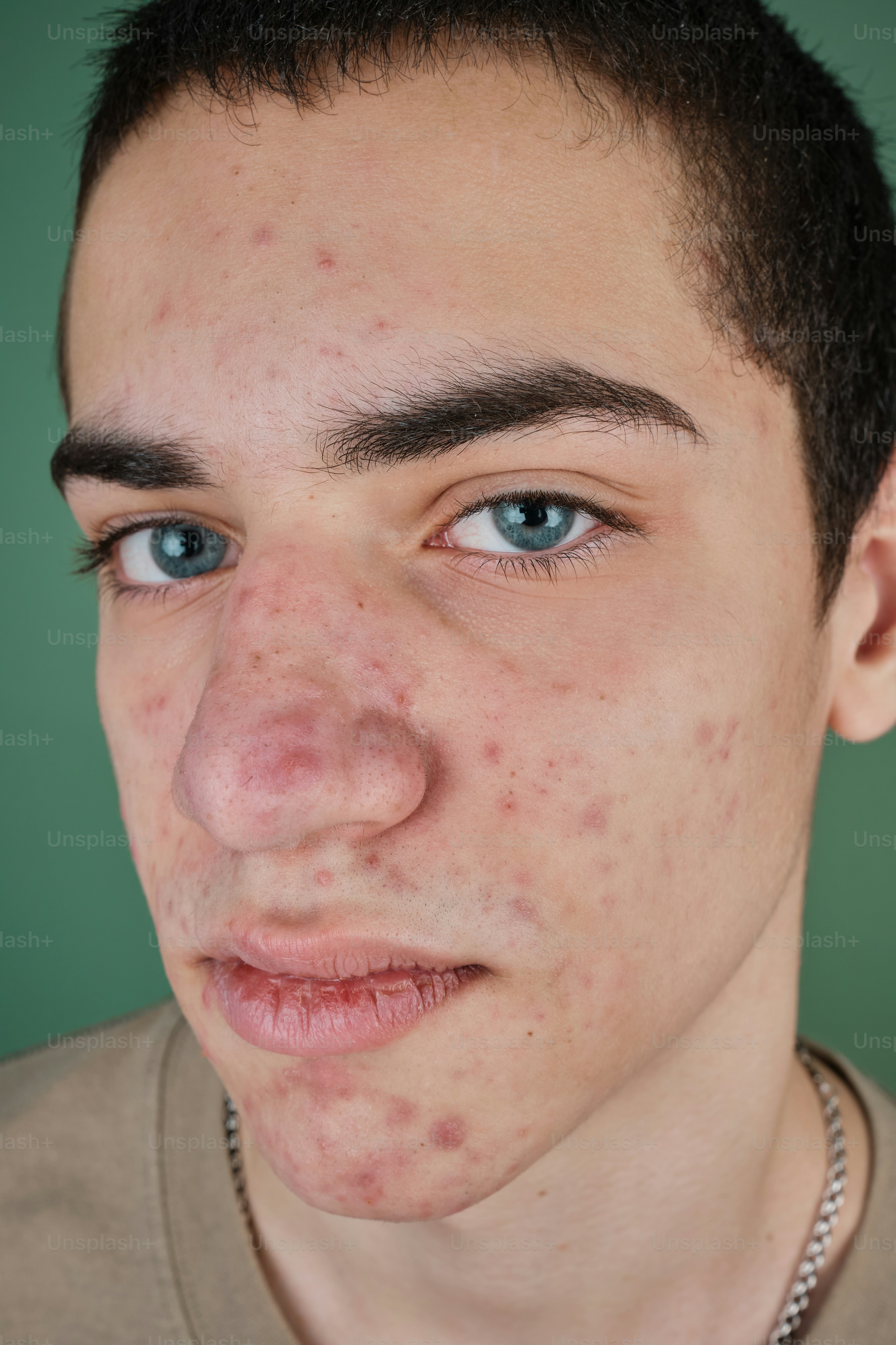 Studio portrait of guy with acne