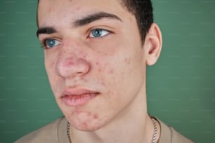 a young man with freckles on his face
