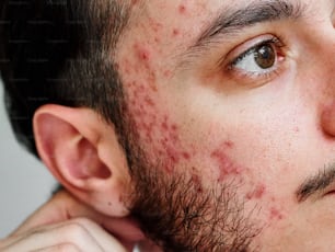 a close up of a man with acne on his face