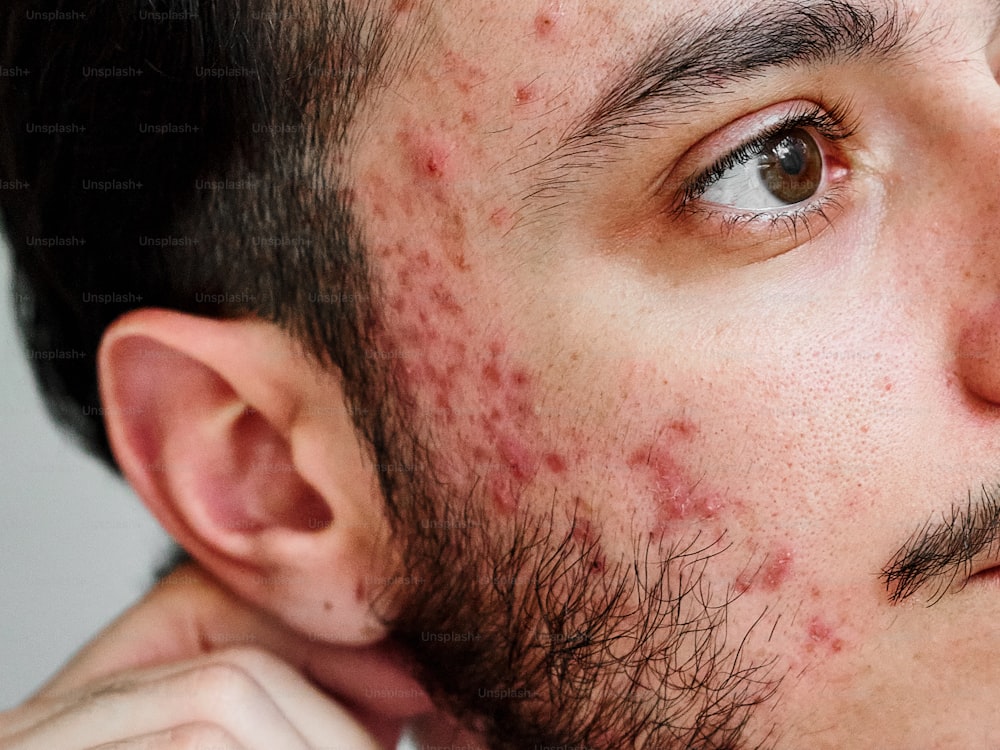 um close up de um homem com acne no rosto