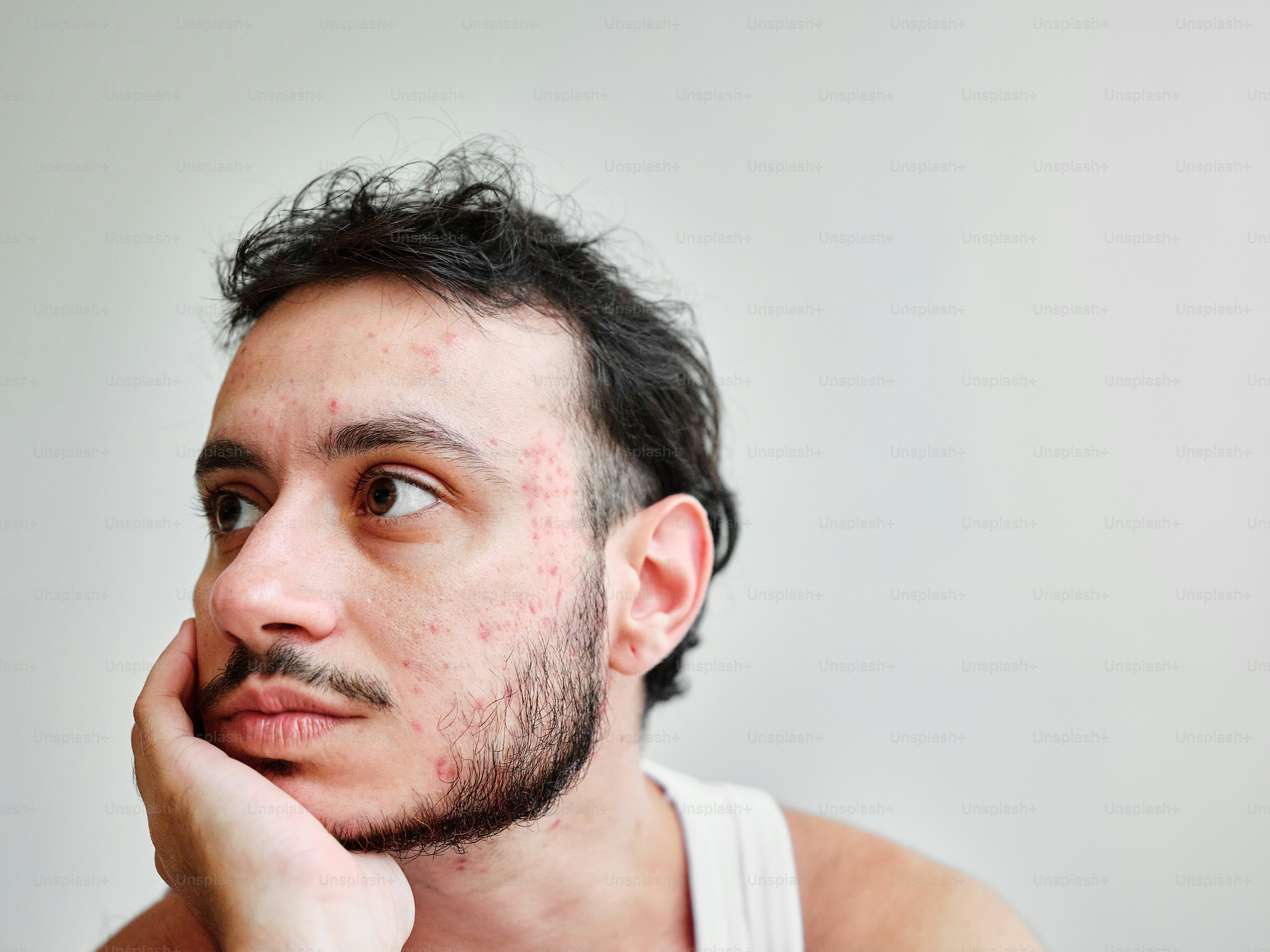 a man with freckles on his face looking at the camera
