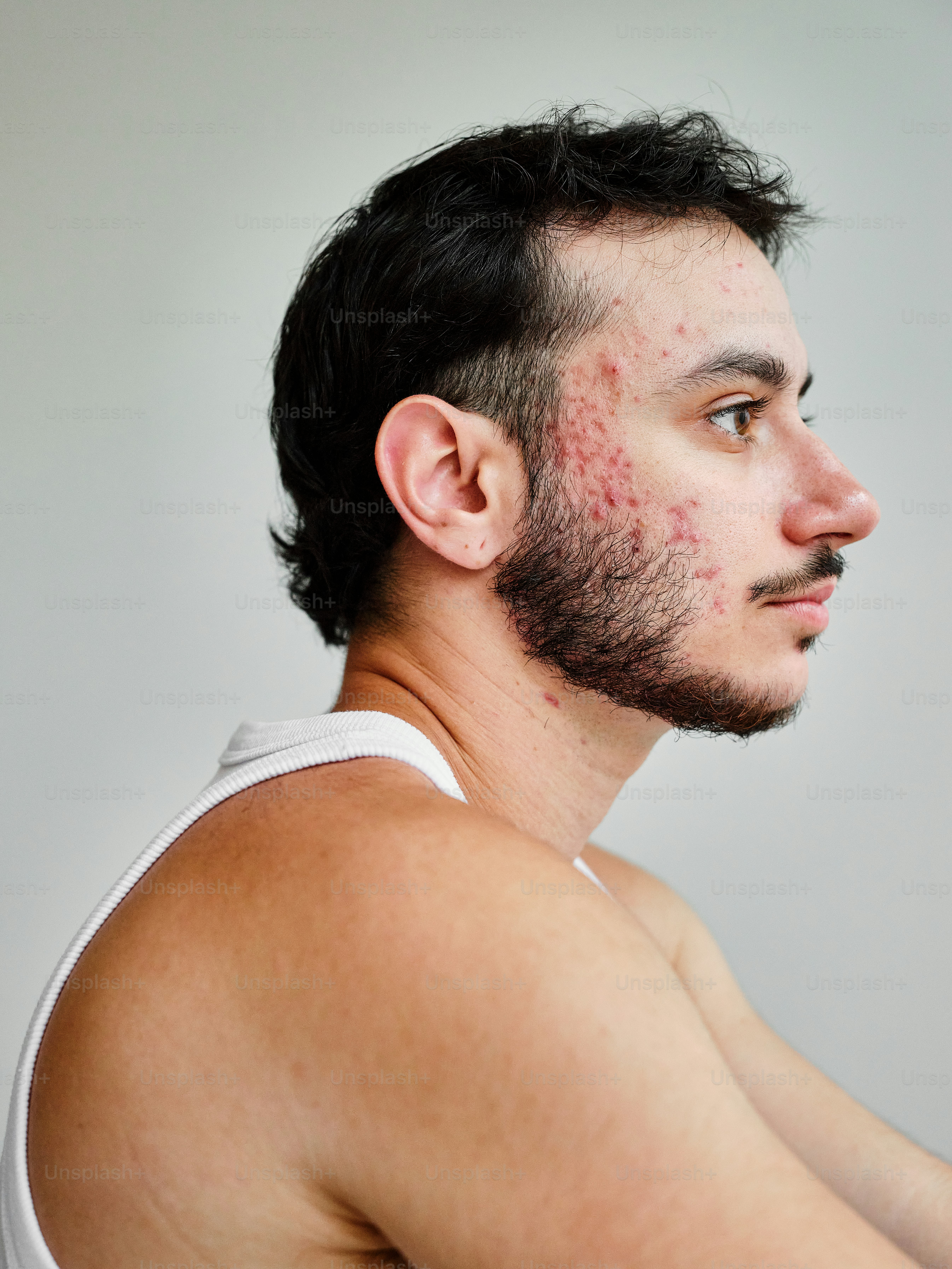 Perfil de um homem jovem de pele clara e cabelo escuro, com foco nítido na textura real da pele apresentando acne ativa e vermelhidão na região da bochecha e maxilar. Ele veste uma regata branca e mantém uma expressão neutra olhando para a frente, em uma representação natural e sem retoques da pele.