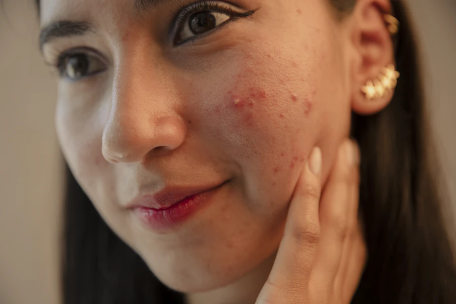 Before: volunteer with congested, uneven skin texture on the cheeks on day one of the panel