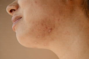 eine Frau mit Akne im Gesicht