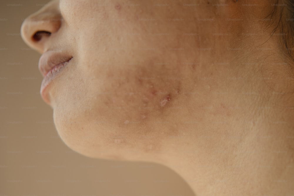 uma mulher com acne em seu rosto