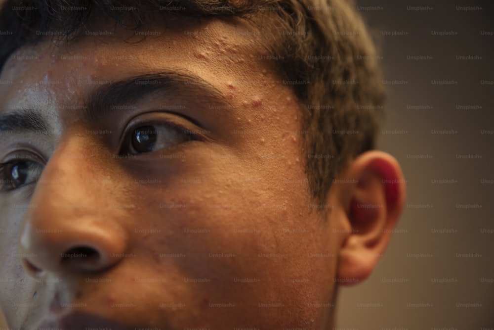 un gros plan d’un jeune homme avec de l’acné sur le visage