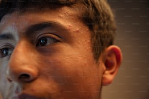 Un primer plano de un joven con acné en la cara