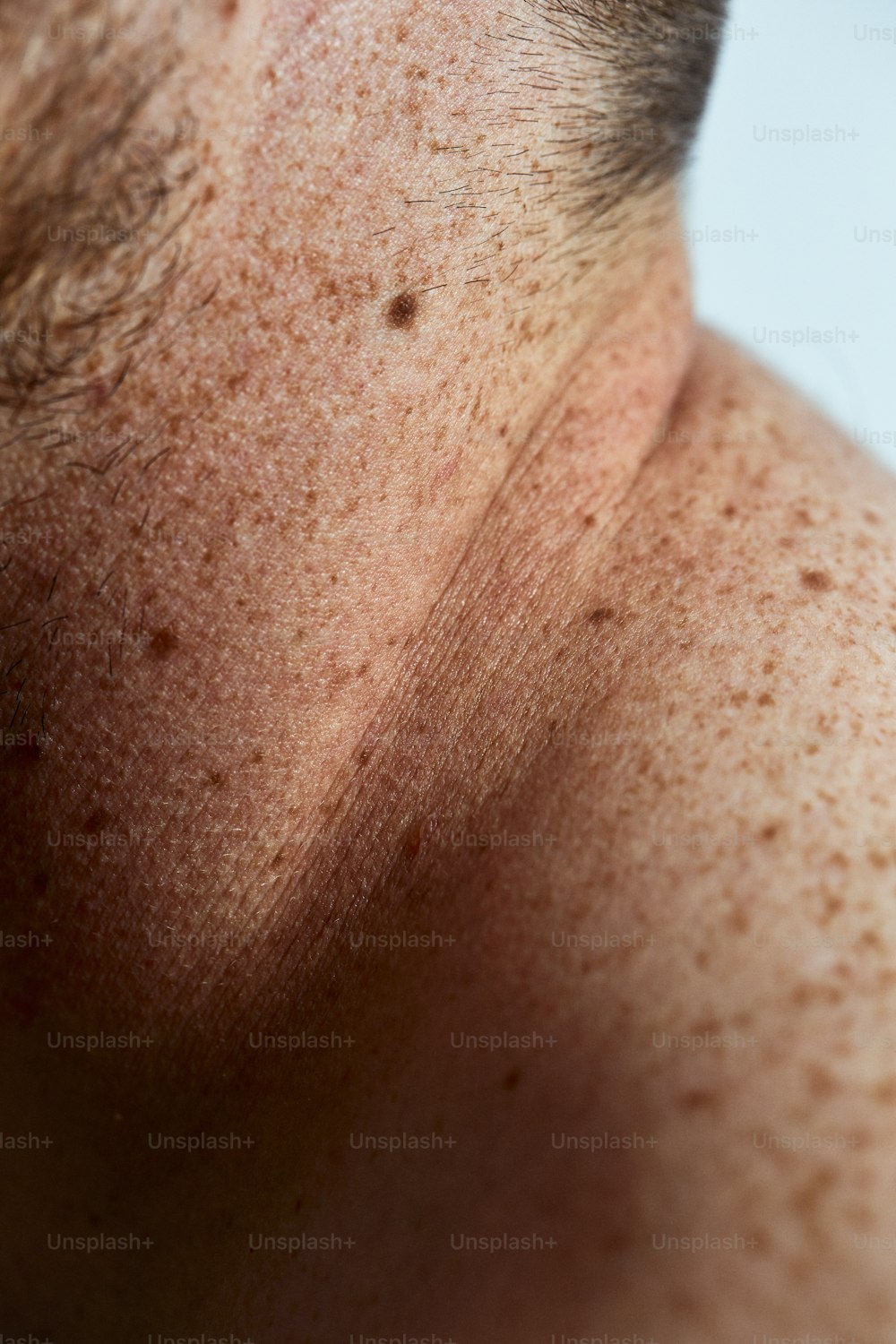 the back of a man's head with freckles on it