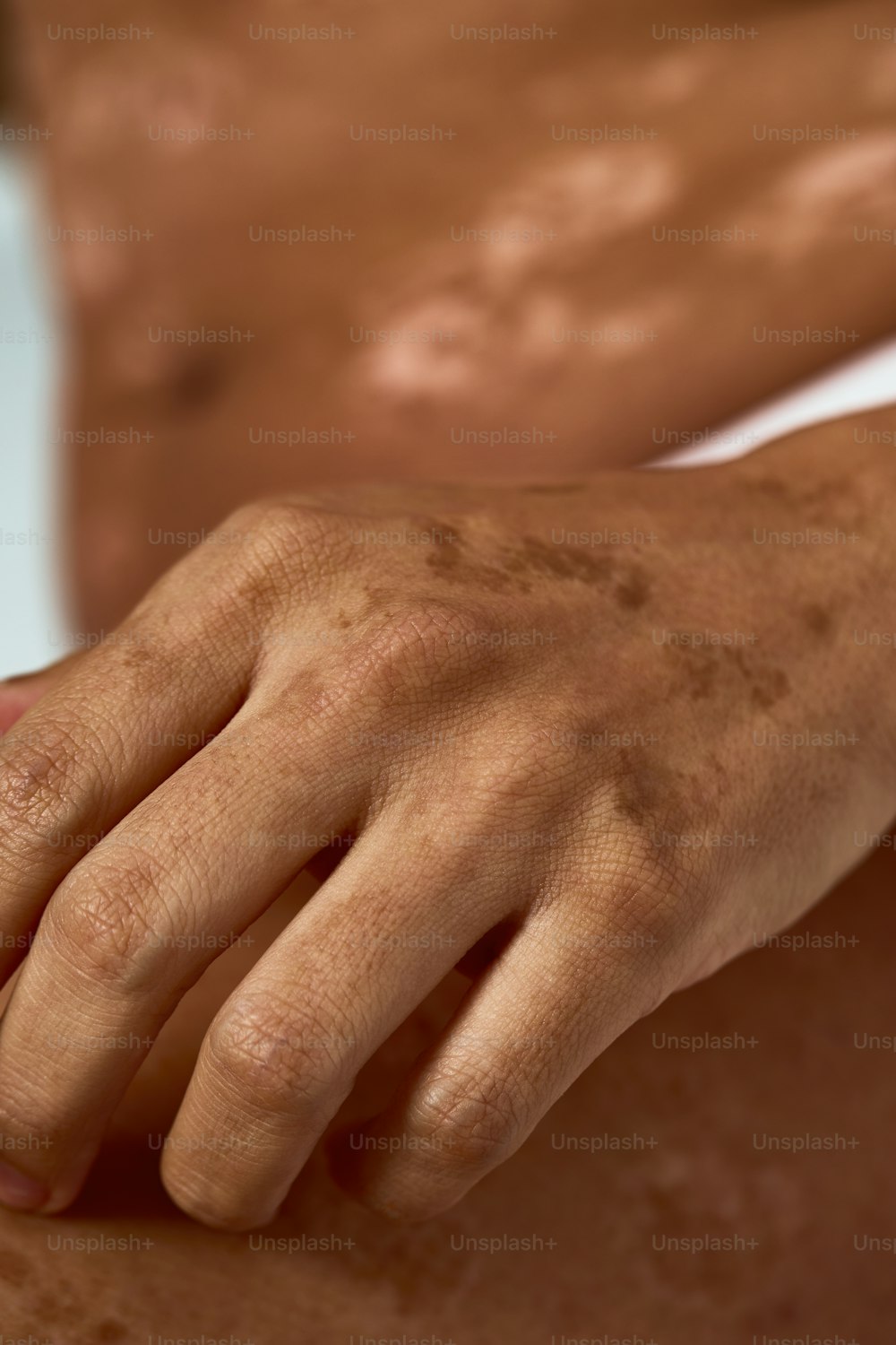 Eine Nahaufnahme des Armes einer Person mit vielen braunen Flecken