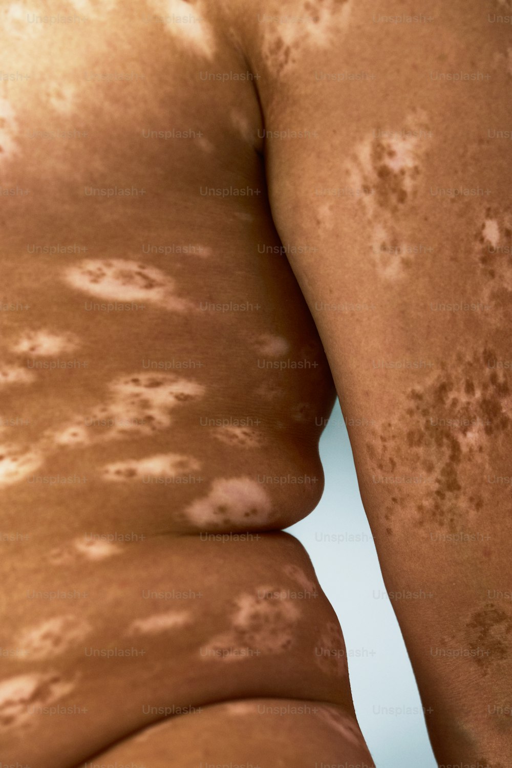 la espalda de una mujer con muchas manchas marrones