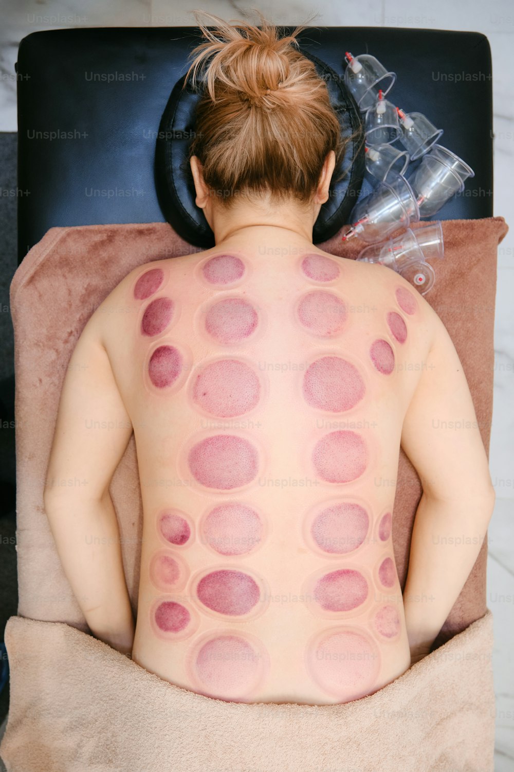 a woman with a lot of spots on her back