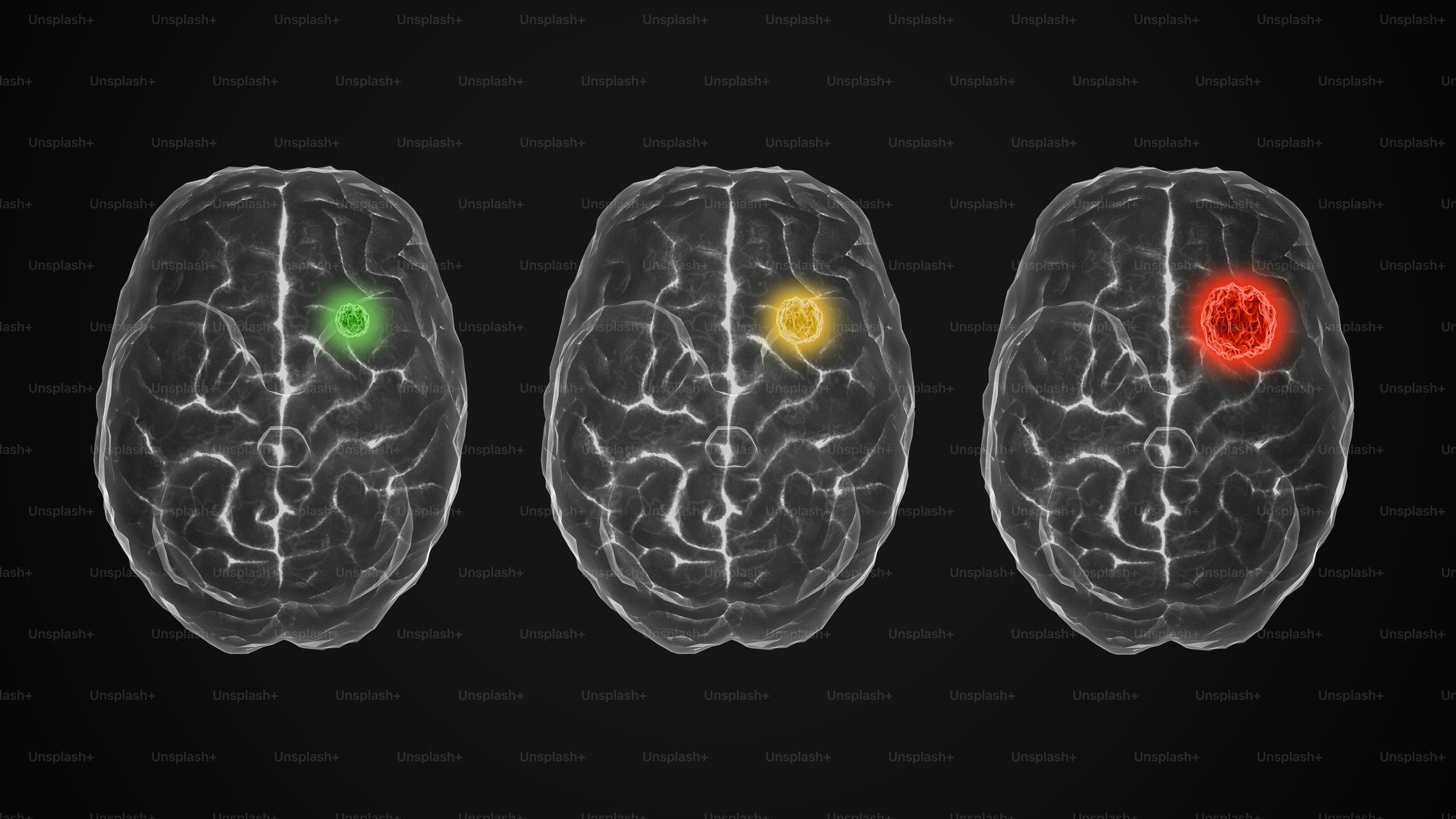 Three different areas of the brain with different colored areas