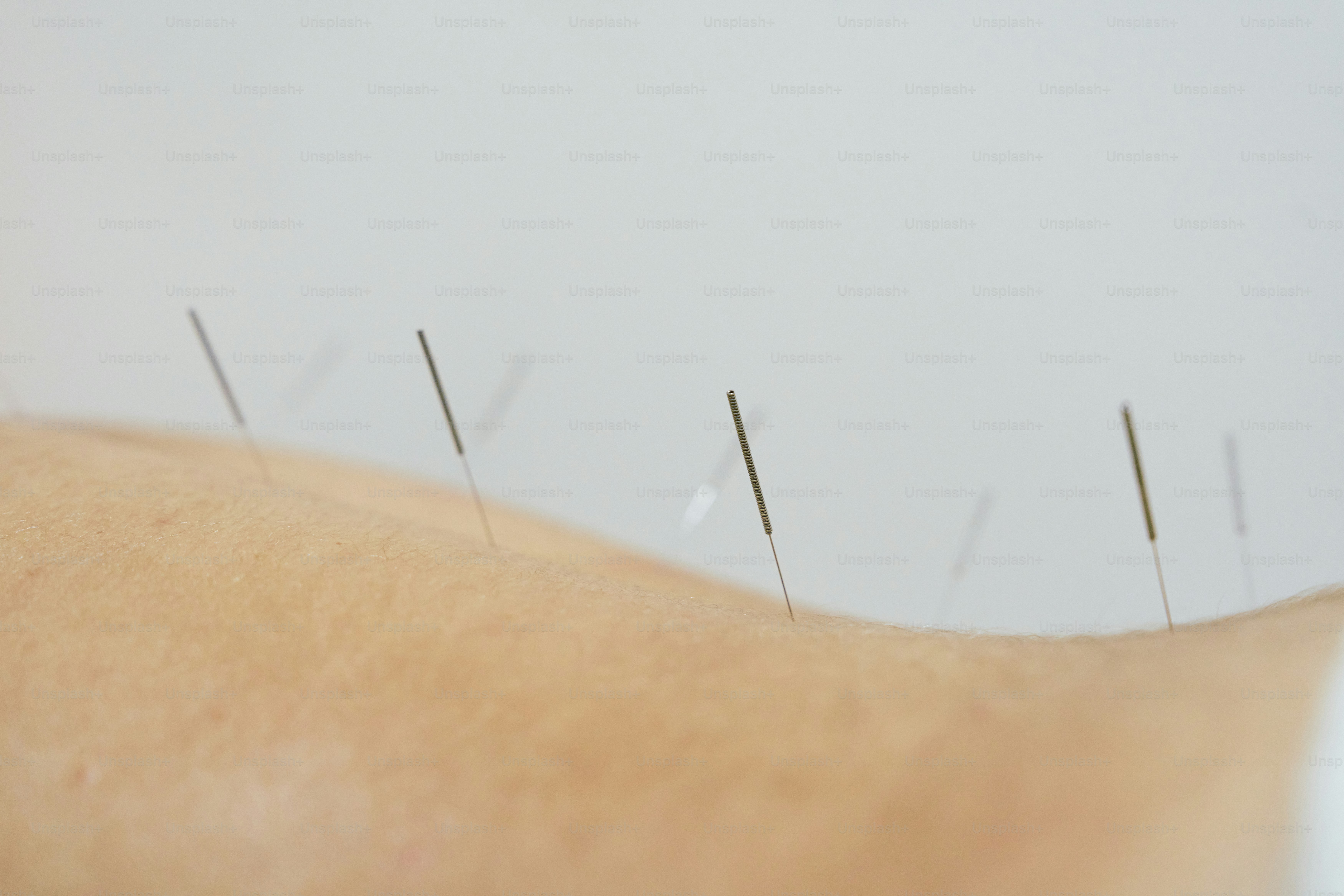 Dry needling close-up