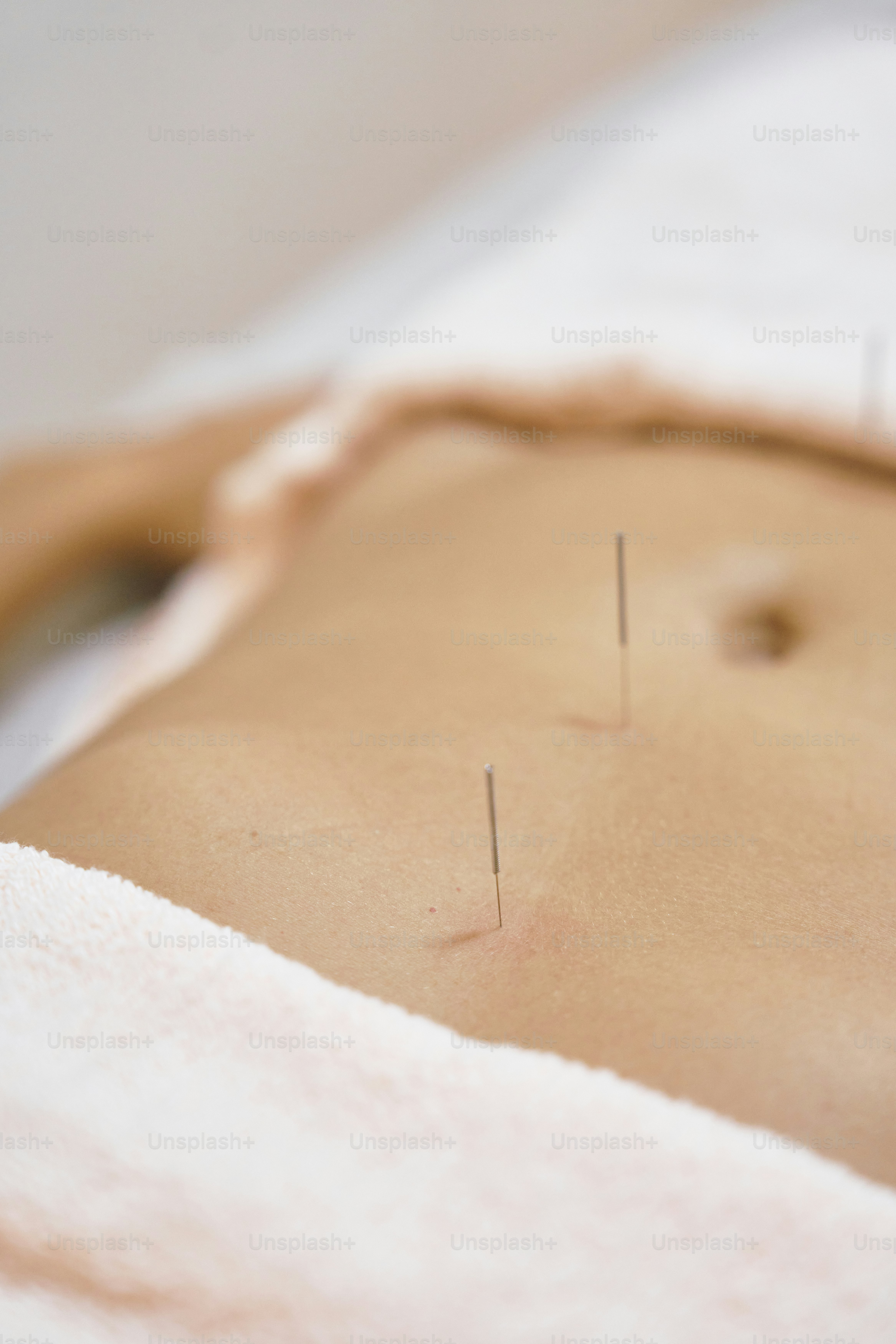 Acupuncture session for pain relief