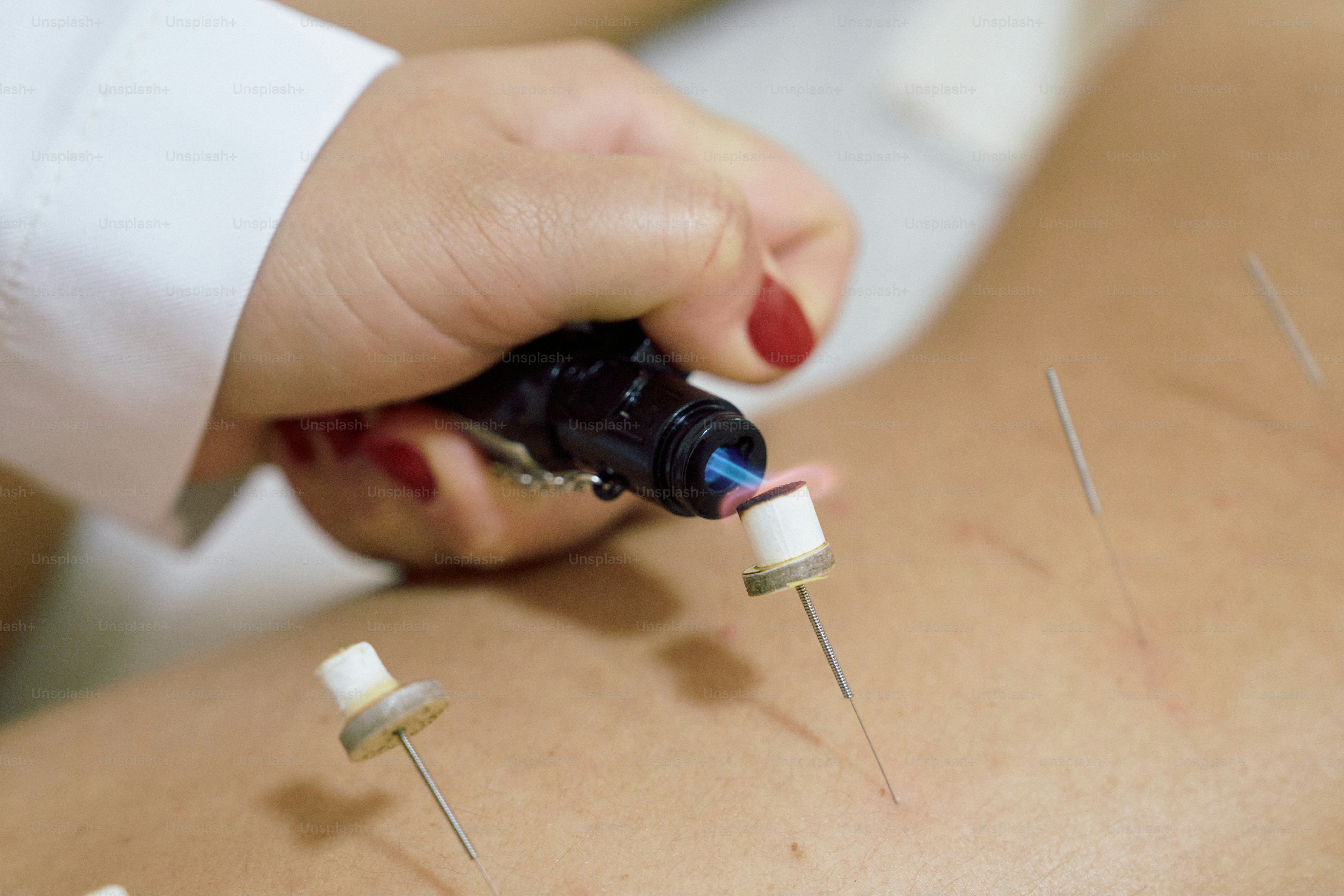 Eine Frau, die Akupulationen auf dem Rücken bekommt