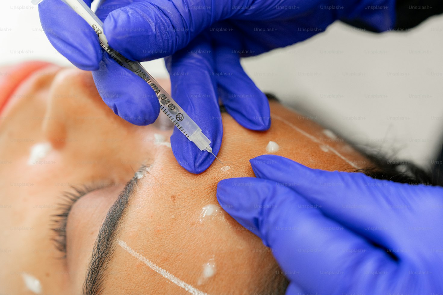 Biorevitalización Facial