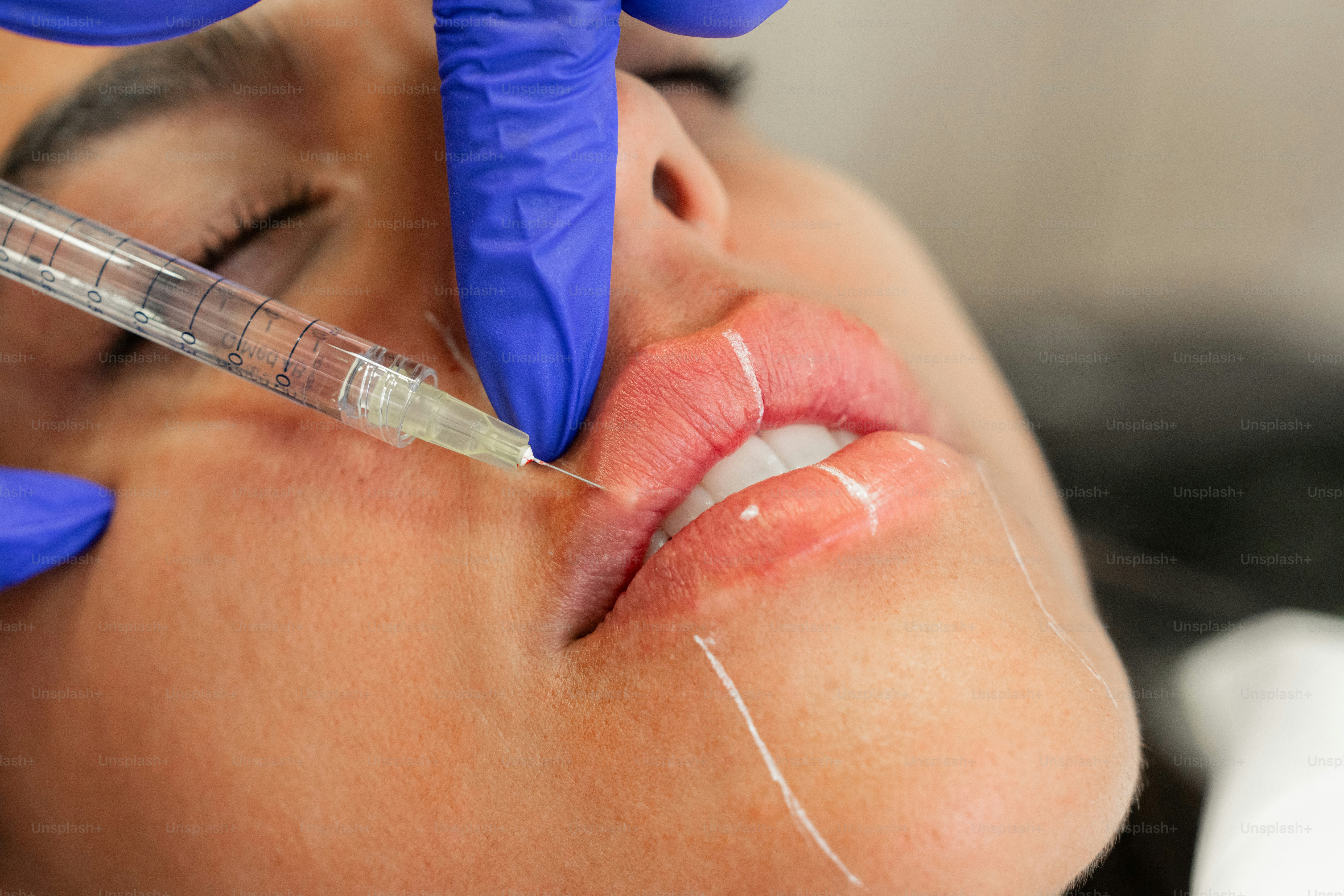 A woman getting a botilage injection from a doctor